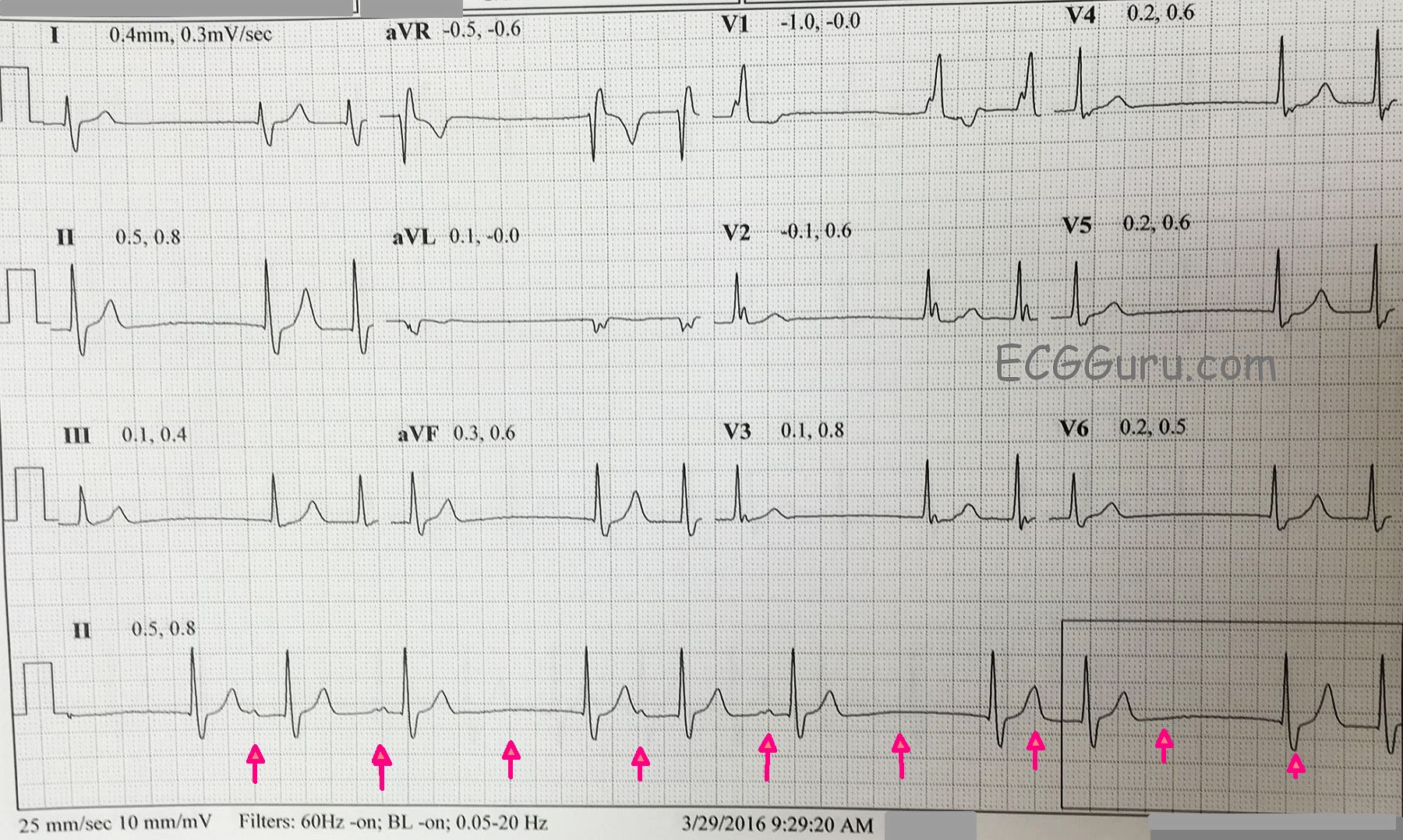 an-irregular-bradycardia-ecg-guru-instructor-resources